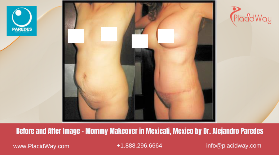 Mommy Makeover in Mexicali Mexico