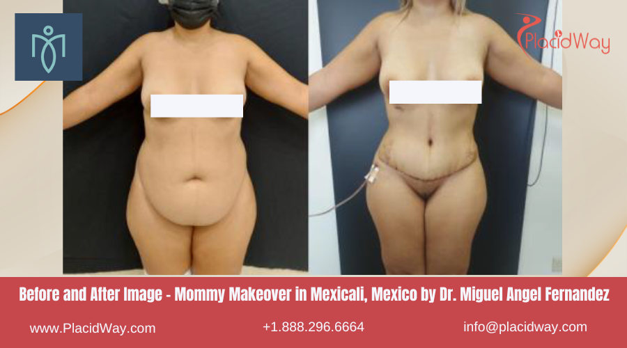 Mommy Makeover in Mexicali Mexico