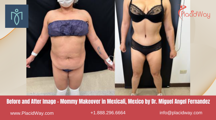 Mommy Makeover in Mexicali Mexico