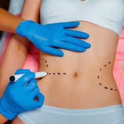 Liposuction Package by Medina Flores in Merida, Mexico - $4,500