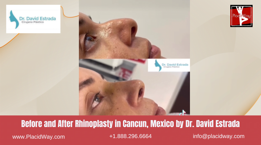 Nose Surgery in Cancun, Mexico Before and After Images