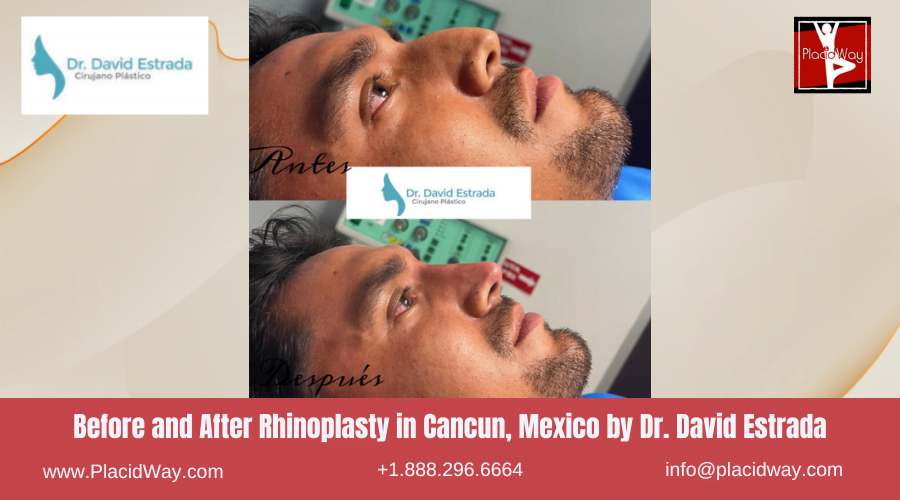 Nose Surgery in Cancun, Mexico Before and After Images