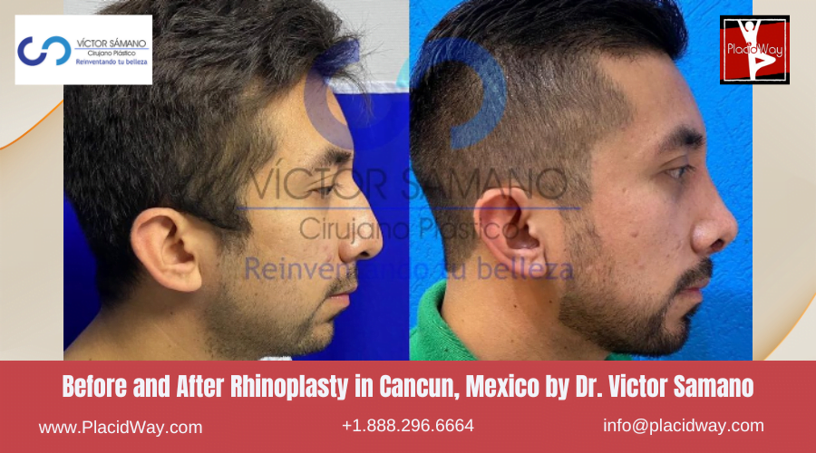 Nose Surgery in Cancun, Mexico Before and After Images