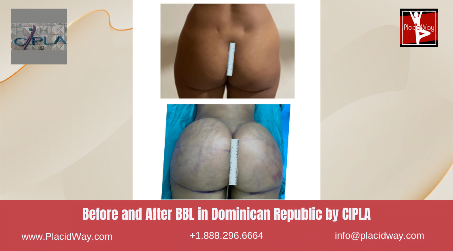 Brazilian Butt Lift in Dominican Republic Before and After Images