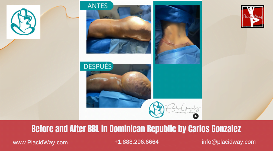 Brazilian Butt Lift in Dominican Republic Before and After Images