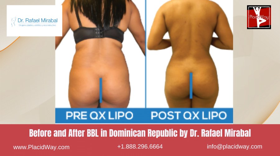 Brazilian Butt Lift in Dominican Republic Before and After Images