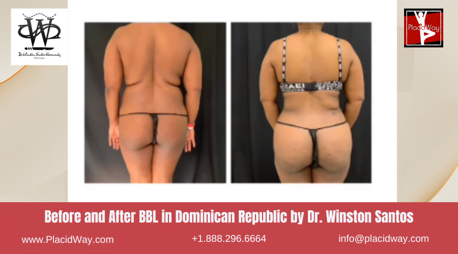 Brazilian Butt Lift in Dominican Republic Before and After Images