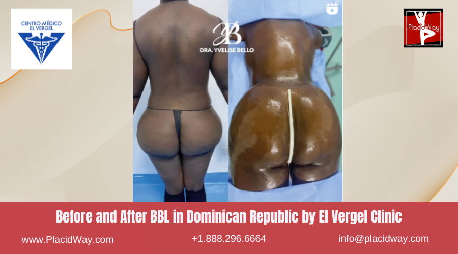 Brazilian Butt Lift in Dominican Republic Before and After Images