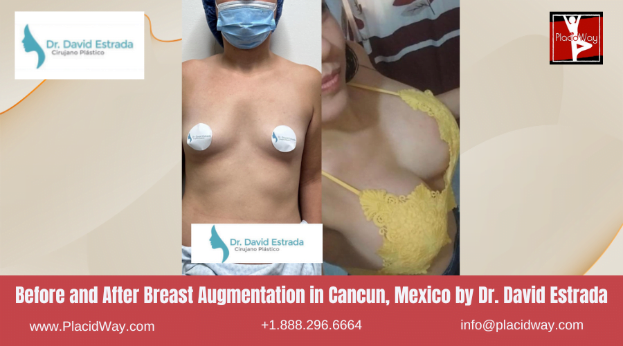 Breast Augmentation in Cancun, Mexico Dr. David Estrada