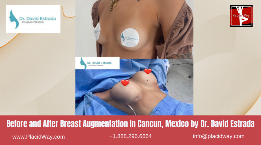 Breast Augmentation in Cancun, Mexico Dr. David Estrada