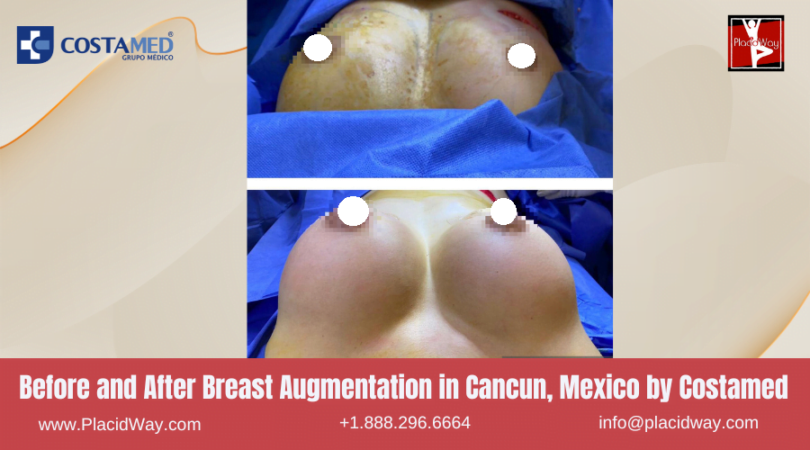 Breast Augmentation in Cancun, Mexico by Costamed