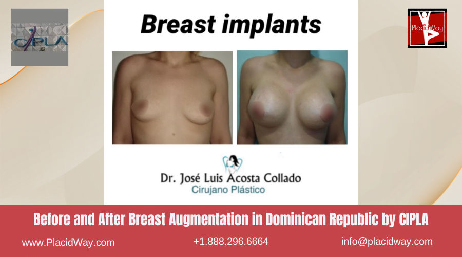 Breast Augmentation in Dominican Republic Before and After Images