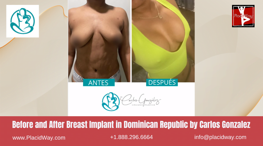 Breast Augmentation in Dominican Republic Before and After Images