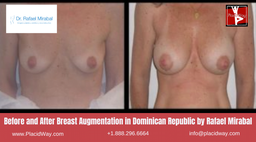 Breast Augmentation in Dominican Republic Before and After Images