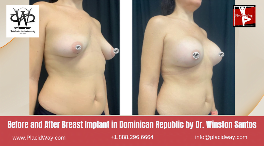 Breast Augmentation in Dominican Republic Before and After Images