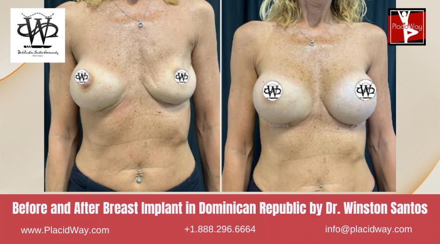 Breast Augmentation in Dominican Republic Before and After Images