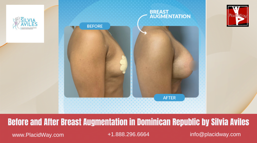 Breast Augmentation in Dominican Republic Before and After Images