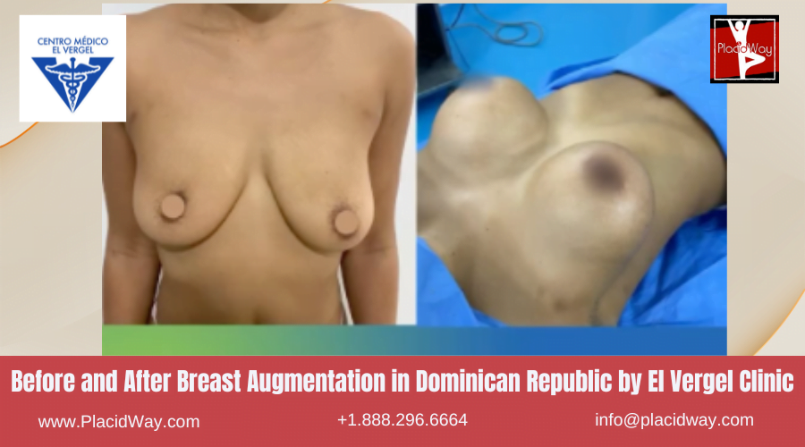 Breast Augmentation in Dominican Republic Before and After Images