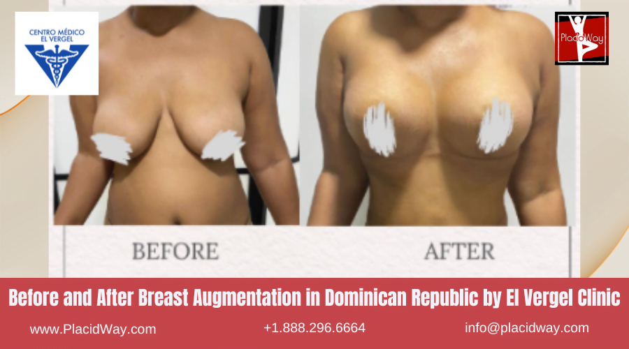 Breast Augmentation in Dominican Republic Before and After Images