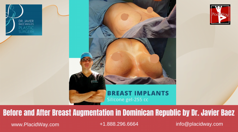 Breast Augmentation in Dominican Republic Before and After Images