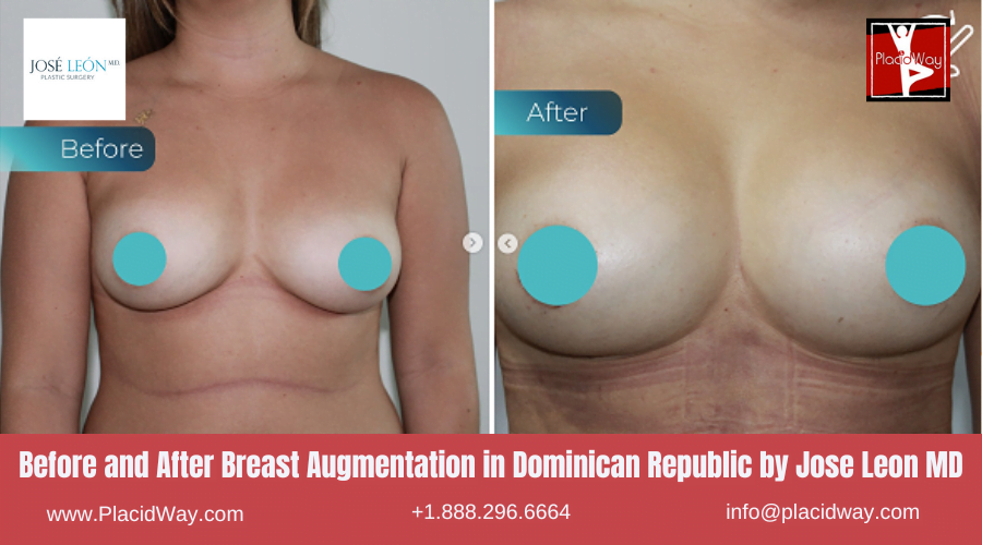 Breast Augmentation in Dominican Republic Before and After Images