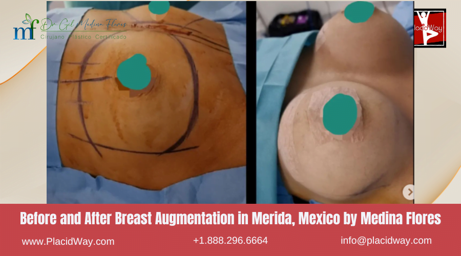 Breast Augmentation in Merida, Mexico by Medina Flores