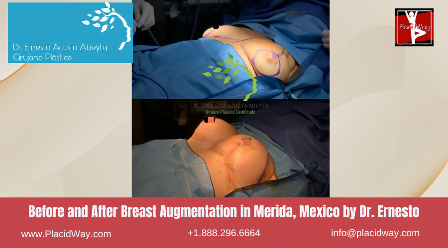 Breast Augmentationin Merida, Mexico by Dr Ernesto Acosta Abeyta