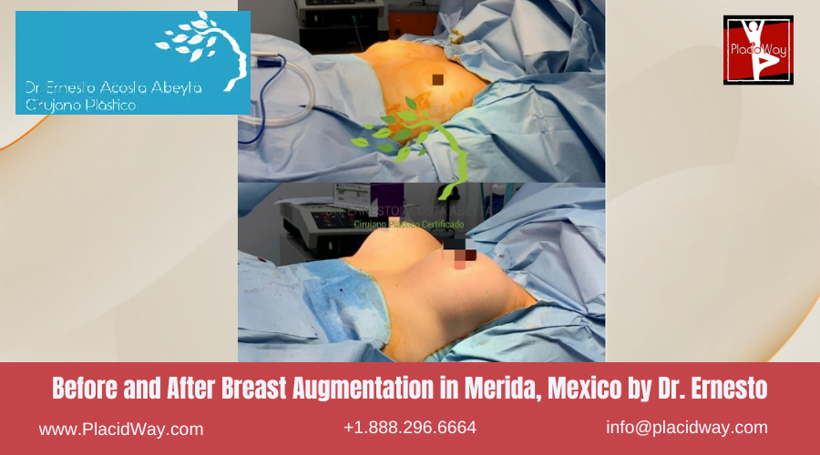 Breast Augmentationin Merida, Mexico by Dr Ernesto Acosta Abeyta