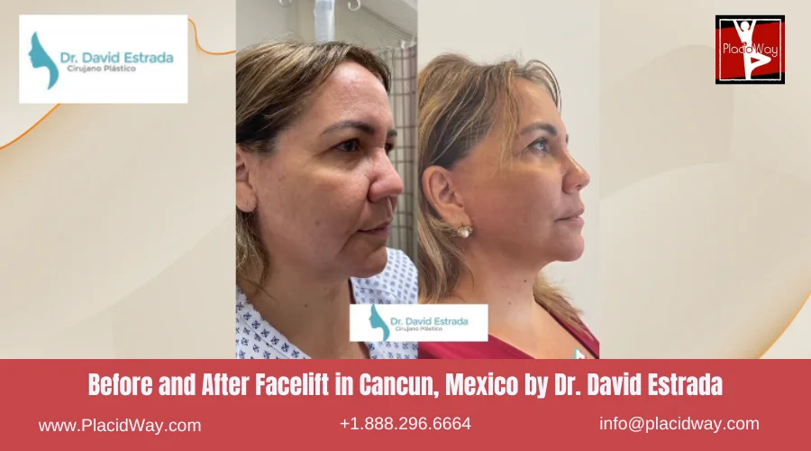 Facelift in Cancun, Mexico Dr. David Estrada
