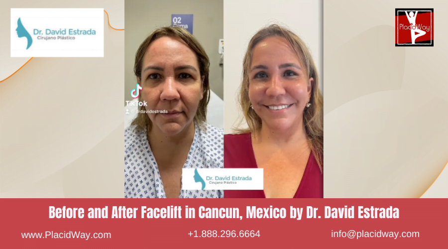 Facelift in Cancun, Mexico Dr. David Estrada