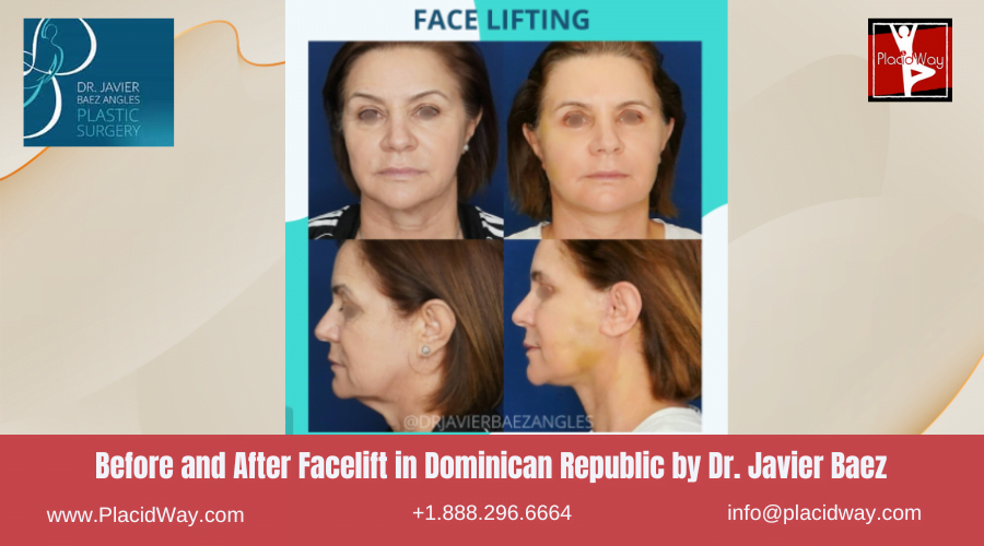 Facelift in Dominican Republic Before and After Images