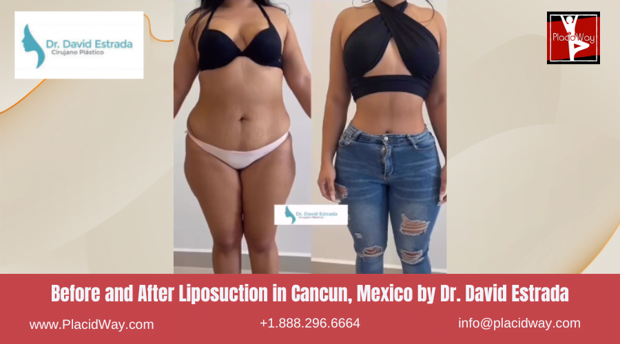 Liposuction in Cancun, Mexico Dr. David Estrada