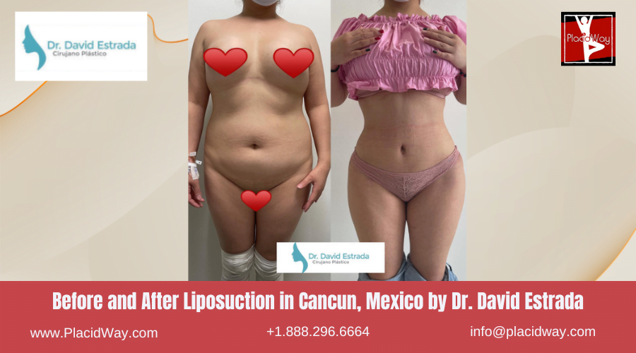 Liposuction in Cancun, Mexico Dr. David Estrada