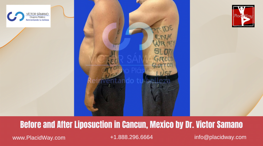 Liposuction in Cancun, Mexico Dr. Victor Samano