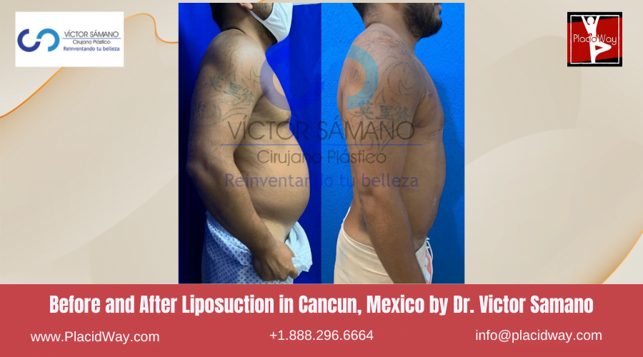 Liposuction in Cancun, Mexico Dr. Victor Samano