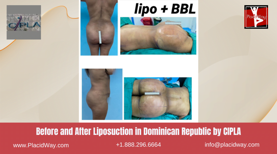 Liposuction in Dominican Republic Before and After Images