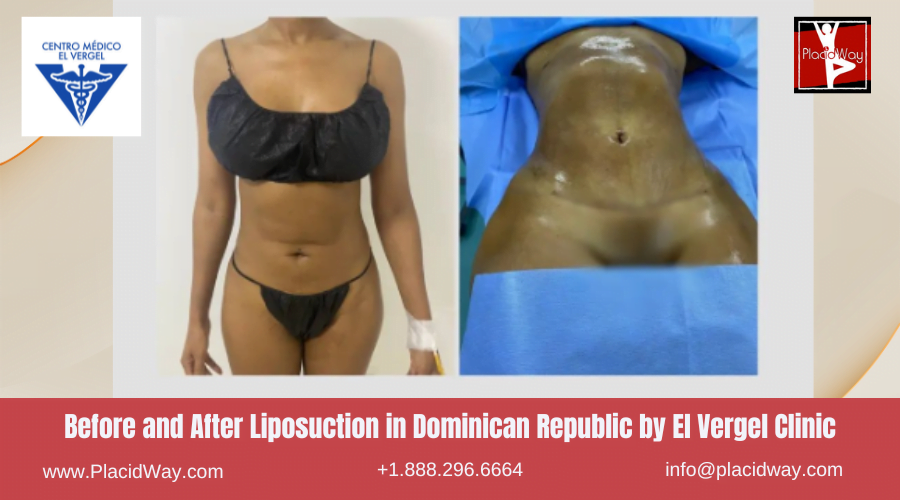 Liposuction in Dominican Republic Before and After Images