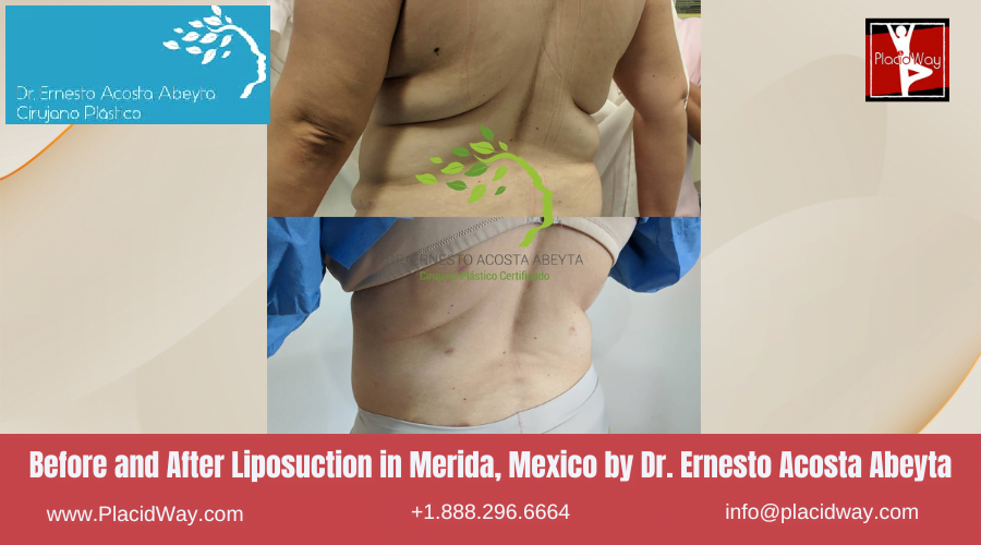 Liposuction in Merida, Mexico by Dr Ernesto Acosta Abeyta