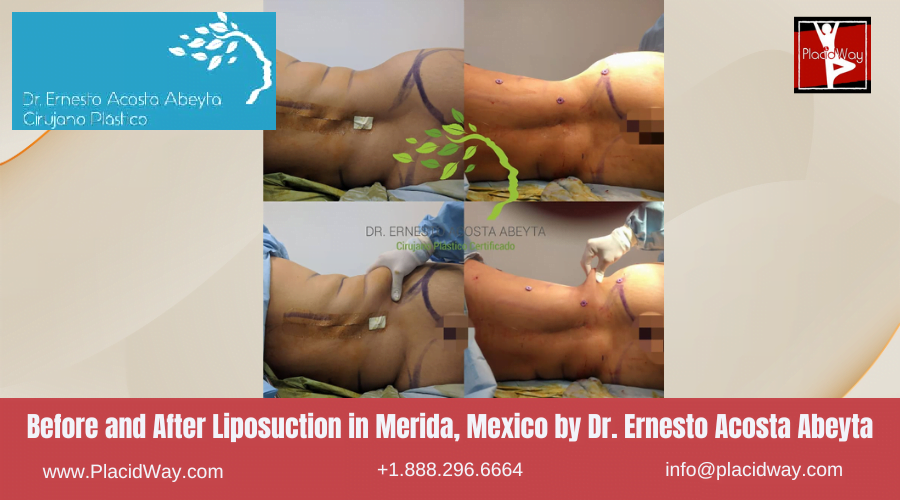 Liposuction in Merida, Mexico by Dr Ernesto Acosta Abeyta