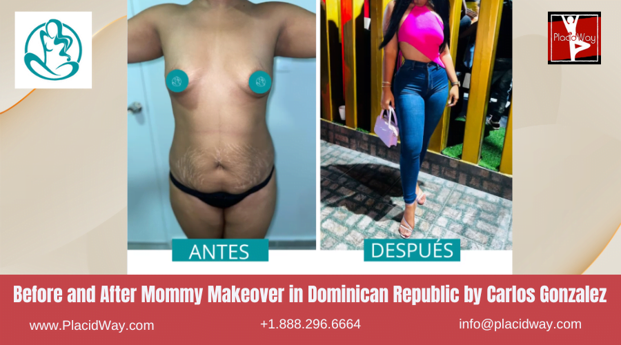 Mommy Makeover Before After Images in Dominican Republic