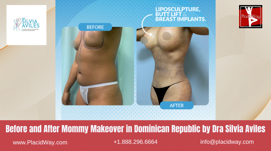 Mommy Makeover Before After Images in Dominican Republic