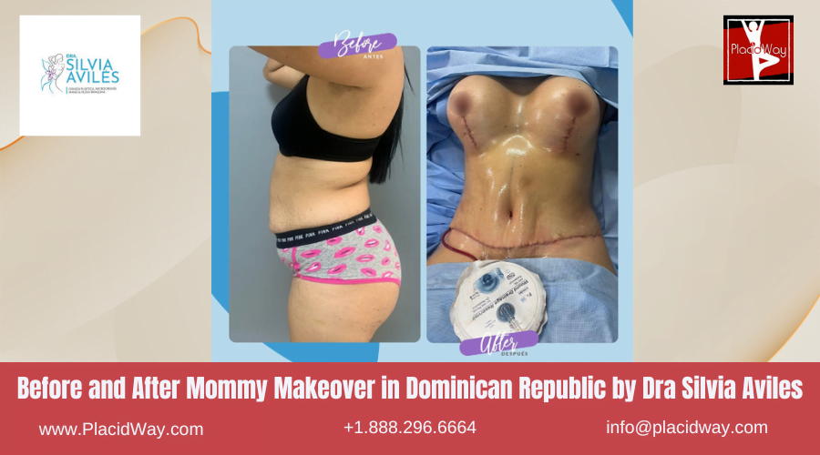 Mommy Makeover Before After Images in Dominican Republic