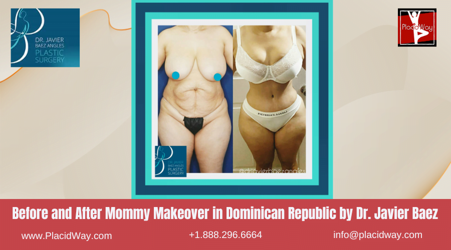 Mommy Makeover Before After Images in Dominican Republic