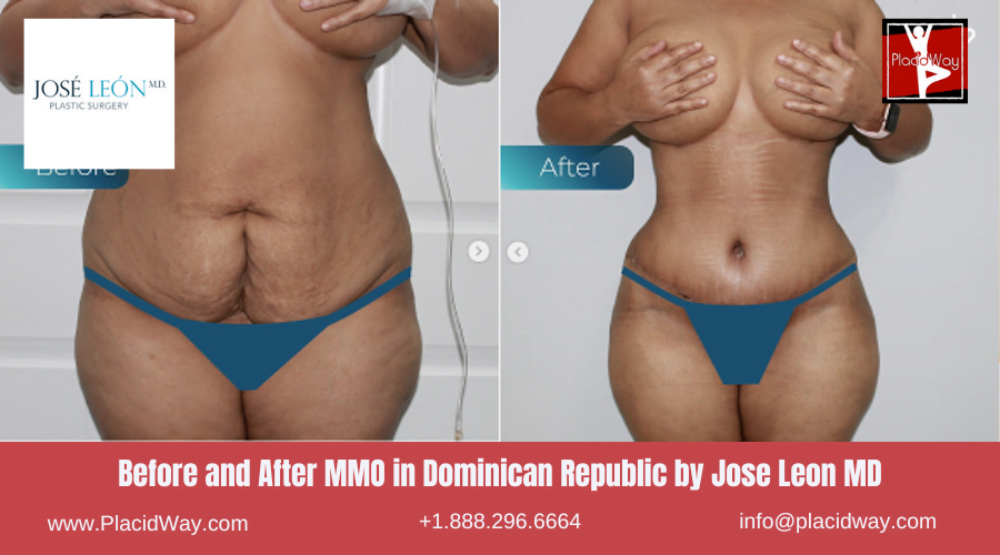Mommy Makeover Before After Images in Dominican Republic