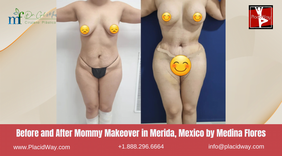 Mommy Makeover in Merida, Mexico Before and After Images