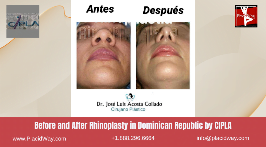 Rhinoplasty in Dominican Republic Before and After Images