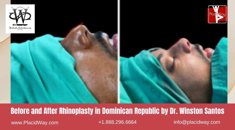 Rhinoplasty in Dominican Republic Before and After Images