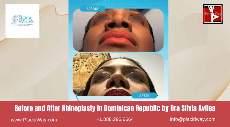 Rhinoplasty in Dominican Republic Before and After Images