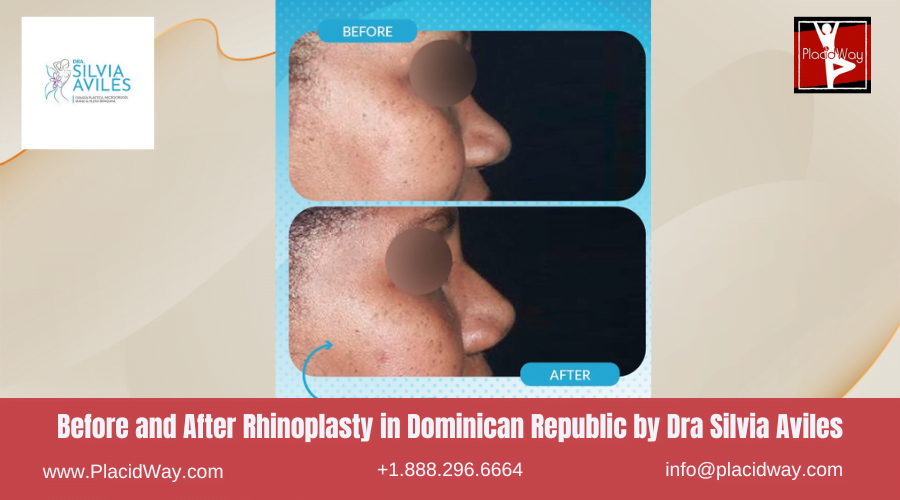 Rhinoplasty in Dominican Republic Before and After Images