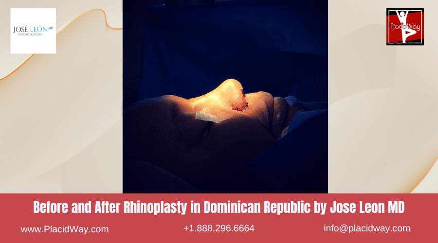 Rhinoplasty in Dominican Republic Before and After Images